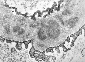 membranoproliferative glomerulonephritis membranoproliferative glomerulonephritis